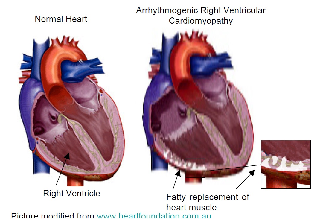 Arrhythmogenic Right Ventricular Cardiomyopathy CIDG